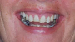 Smile before cosmetic dental treatment, gallery case 6 detail view