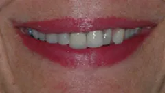 Smile before cosmetic dental treatment, gallery case 7 detail view