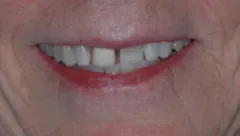 Smile before cosmetic dental treatment, gallery case 8 detail view