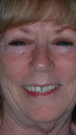 Smile before cosmetic dental treatment, gallery case 8