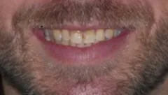 Smile before cosmetic dental treatment, gallery case 9 detail view