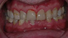 Smile before cosmetic dental treatment, gallery case 11 detail view