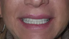 Smile before cosmetic dental treatment, gallery case 13 detail view