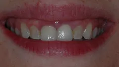 Smile before cosmetic dental treatment, gallery case 14 detail view
