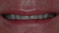 Smile before cosmetic dental treatment, gallery case 15 detail view