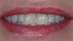 Smile before cosmetic dental treatment, gallery case 16 detail view