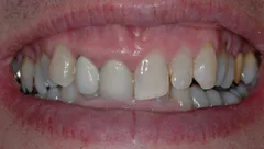 Smile before cosmetic dental treatment, gallery case 17 detail view