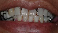 Smile before cosmetic dental treatment, gallery case 18 detail view