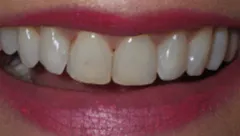 Smile before cosmetic dental treatment, gallery case 19 detail view