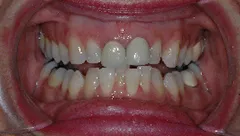 Smile before cosmetic dental treatment, gallery case 21 detail view