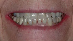 Smile before cosmetic dental treatment, gallery case 22 detail view