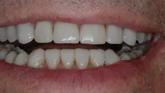 Smile before cosmetic dental treatment, gallery case 23 detail view