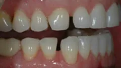 Smile before cosmetic dental treatment, gallery case 24 detail view