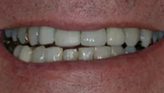 Smile before cosmetic dental treatment, gallery case 25 detail view