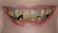 Smile before cosmetic dental treatment, gallery case 26 detail view