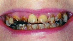 Smile before cosmetic dental treatment, gallery case 27 detail view