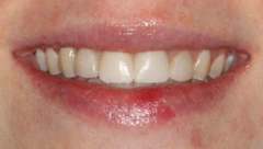 Smile before cosmetic dental treatment, gallery case 28
