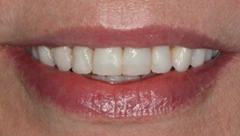 Smile before cosmetic dental treatment, gallery case 29