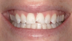 Smile before cosmetic dental treatment, gallery case 30