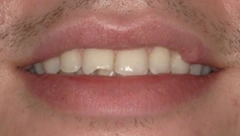 Smile before cosmetic dental treatment, gallery case 31