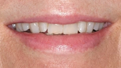 Smile before cosmetic dental treatment, gallery case 32