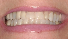 Smile before cosmetic dental treatment, gallery case 33
