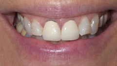 Smile before cosmetic dental treatment, gallery case 34