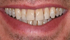 Smile before cosmetic dental treatment, gallery case 35