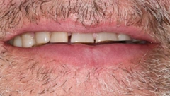 Smile before cosmetic dental treatment, gallery case 36