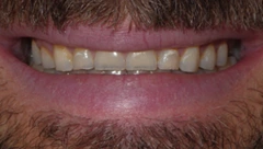 Smile before cosmetic dental treatment, gallery case 37