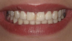 Smile before cosmetic dental treatment, gallery case 38