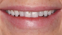 Smile before cosmetic dental treatment, gallery case 39