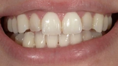 Smile before cosmetic dental treatment, gallery case 40