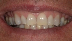 Smile before cosmetic dental treatment, gallery case 41