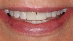 Smile before cosmetic dental treatment, gallery case 42