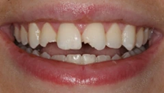Smile before cosmetic dental treatment, gallery case 43