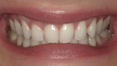 Smile before cosmetic dental treatment, gallery case 44