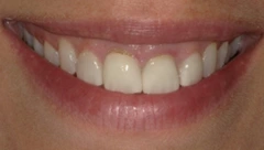 Smile before cosmetic dental treatment, gallery case 45