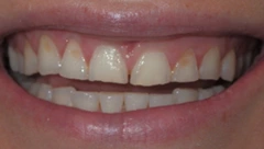 Smile before cosmetic dental treatment, gallery case 46