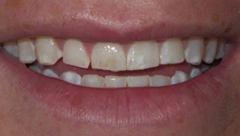 Smile before cosmetic dental treatment, gallery case 47
