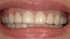 Smile before cosmetic dental treatment, gallery case 48