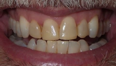 Smile before cosmetic dental treatment, gallery case 49