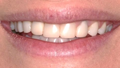 Smile before cosmetic dental treatment, gallery case 50